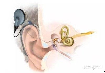 成人可以配耳蜗吗视频,改变听力的新篇章